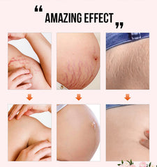 Best Stretch Mark Removal Cream - Reduce Postpartum Obesity And Stretch Marks Repair Essential Oil