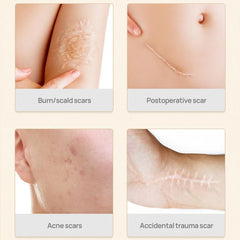 Scar Removal Stretch Marks Serum - Stretch Marks Removal Cream