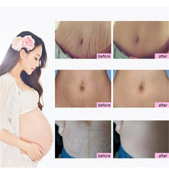 Products to Remove Stretch Marks - Natural Mild Non-irritating Mango Remove Stretch Mark Cream For Pregnancy Repair Scar Slack Line Abdomen Stretch Marks Cream