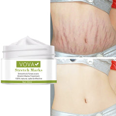 Stretch Marks Removal Cream