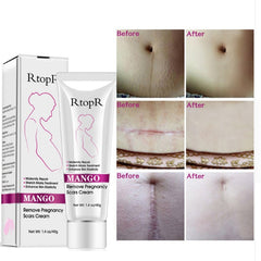 Products to Remove Stretch Marks - Natural Mild Non-irritating Mango Remove Stretch Mark Cream For Pregnancy Repair Scar Slack Line Abdomen Stretch Marks Cream