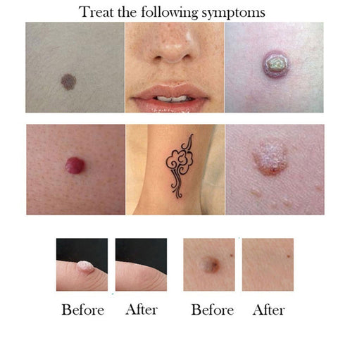 Mole Removal Cream