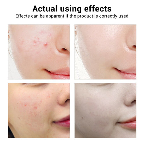 BREYLEE Acne Treatment Face Serum Mask Anti Acne Pimple Scar Remover Moisturizing Whitening Skin Care Facial Essence Cream 17ml - Fashionner