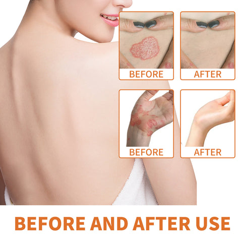 Crème Réparatrice Mousse Anti-Miel Rouge Démangeaisons Hydratante Mains et Pieds