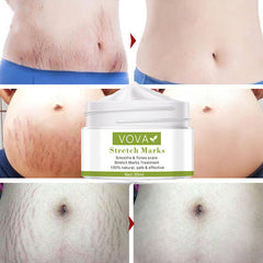 Stretch Marks Removal Cream