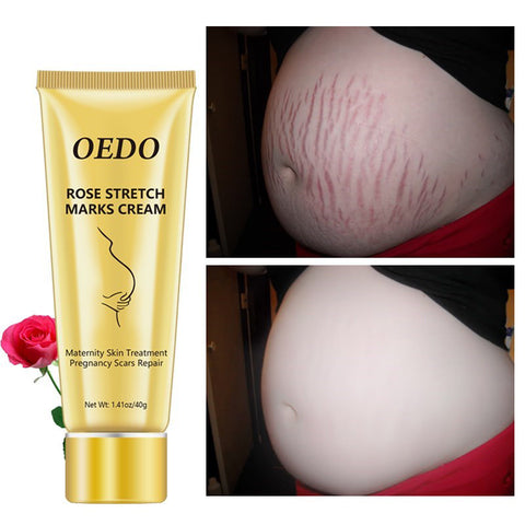 Crème pour réduire les vergetures - Crème anti-âge aux roses pour l'élimination des vergetures