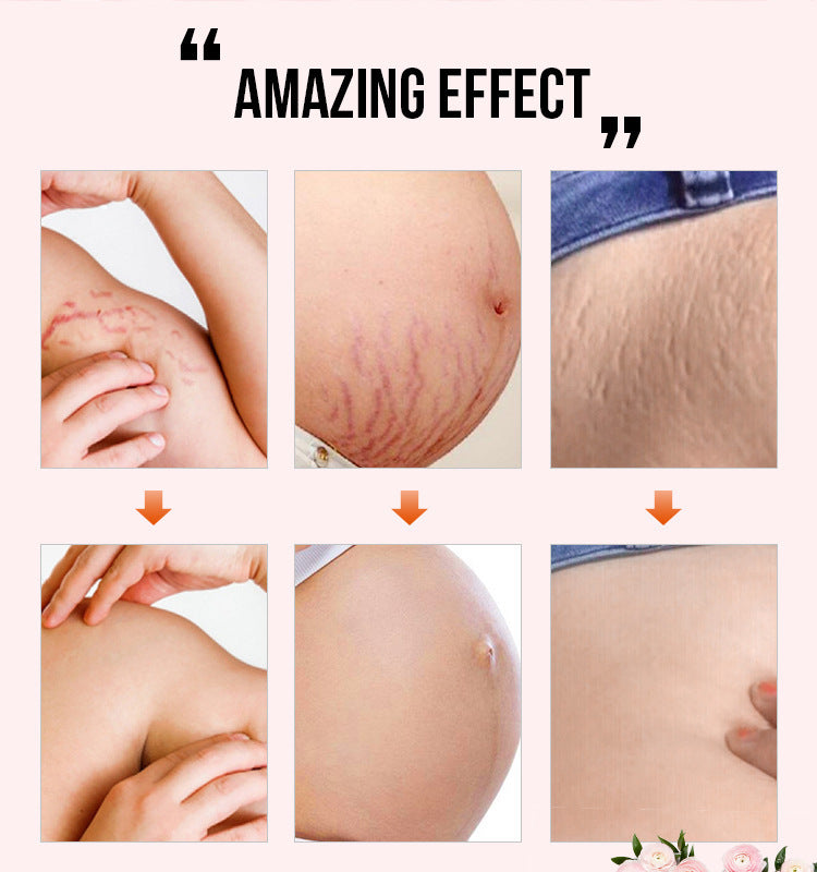 Best Stretch Mark Removal Cream - Reduce Postpartum Obesity And Stretch Marks Repair Essential Oil