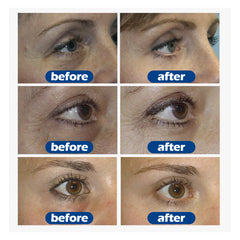 Dark Circles Remove Cream - Best under Eye Cream for Dark Circles