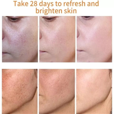 Crème blanchissante efficace contre les taches de rousseur