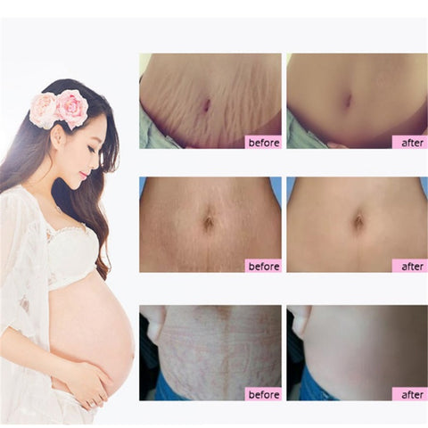 Produits pour enlever les vergetures - Crème naturelle douce et non irritante au mangue pour enlever les vergetures, pour la grossesse, la réparation des cicatrices, la ligne lâche, la crème pour les vergetures abdominales