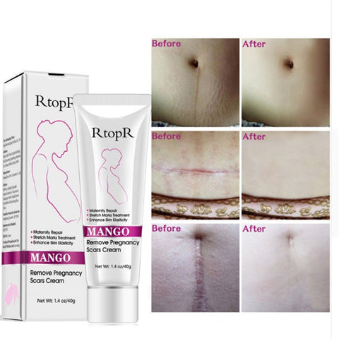 Produits pour enlever les vergetures - Crème naturelle douce et non irritante au mangue pour enlever les vergetures, pour la grossesse, la réparation des cicatrices, la ligne lâche, la crème pour les vergetures abdominales