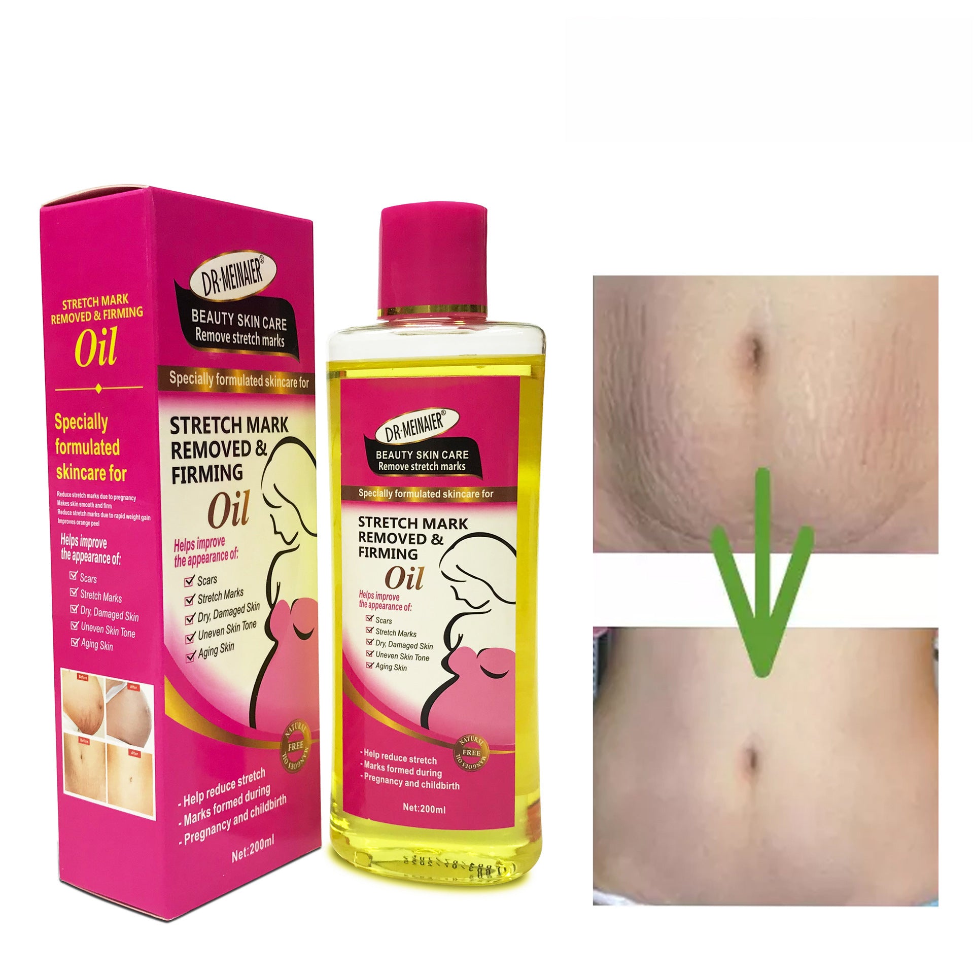 Lotion to Remove Stretch Marks - Stretch Marks Multi-Effect Moisturizing Soothing Oil
