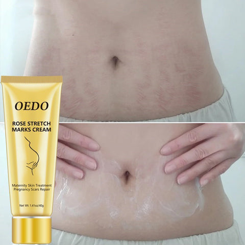 Crème pour réduire les vergetures - Crème anti-âge aux roses pour l'élimination des vergetures