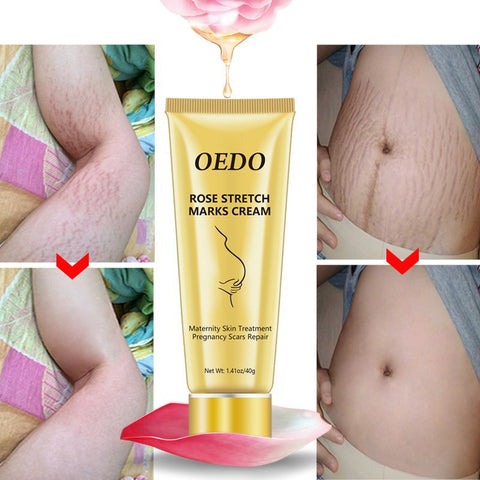 Crème pour réduire les vergetures - Crème anti-âge aux roses pour l'élimination des vergetures