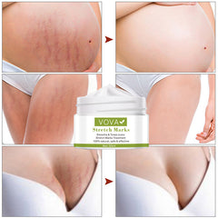 Stretch Marks Removal Cream