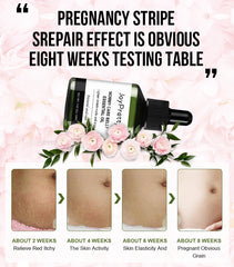 Best Stretch Mark Removal Cream - Reduce Postpartum Obesity And Stretch Marks Repair Essential Oil