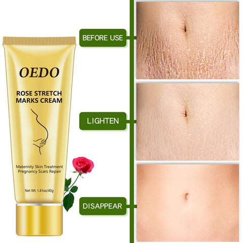 Crème pour réduire les vergetures - Crème anti-âge aux roses pour l'élimination des vergetures