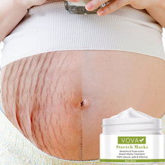 Stretch Marks Removal Cream